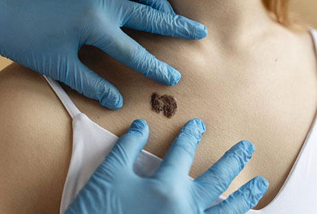 El extracto de cannabis ha demostrado ser efectivo en la lucha contra el cáncer de piel (melanoma)